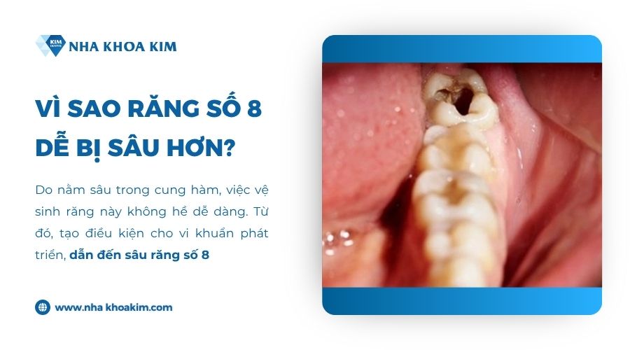 Vì sao răng số 8 dễ bị sâu hơn?