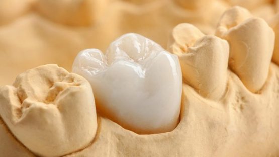 Địa chỉ nào bọc răng sứ ở Hà Nội uy tín và chất lượng nhất?