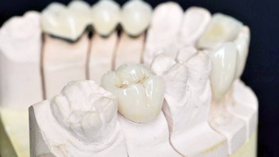 Bọc sứ răng cấm – Giải pháp bảo tồn răng cấm bền chắc lâu dài