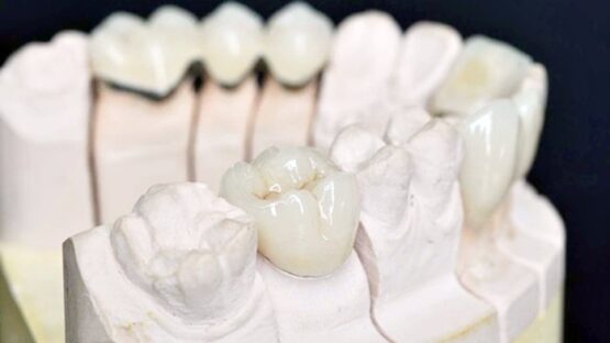 Bọc sứ răng cấm – Giải pháp bảo tồn răng cấm bền chắc lâu dài