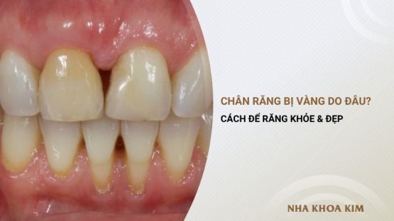 Chân răng bị vàng do đâu? Làm gì để răng trắng đẹp trở lại?