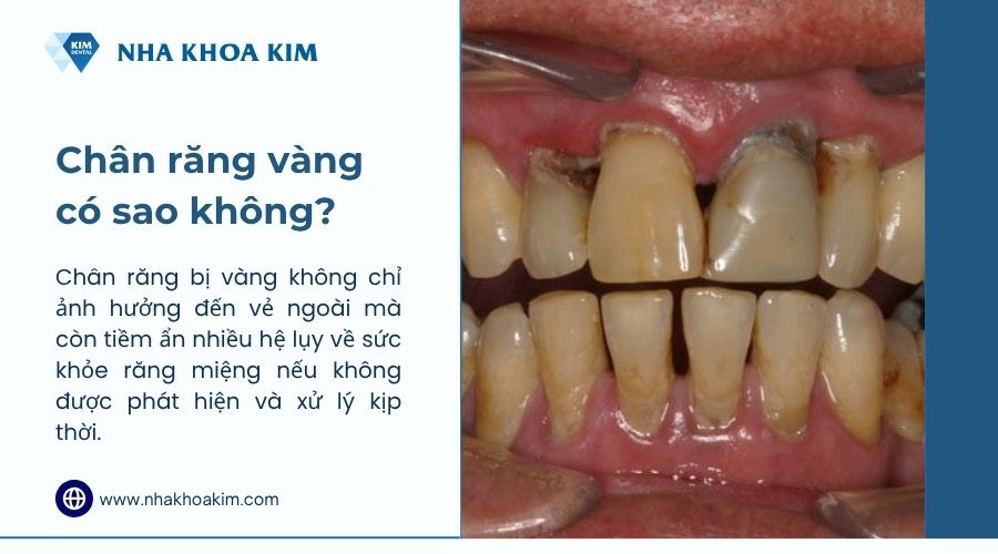 chân răng bị vàng có sao không
