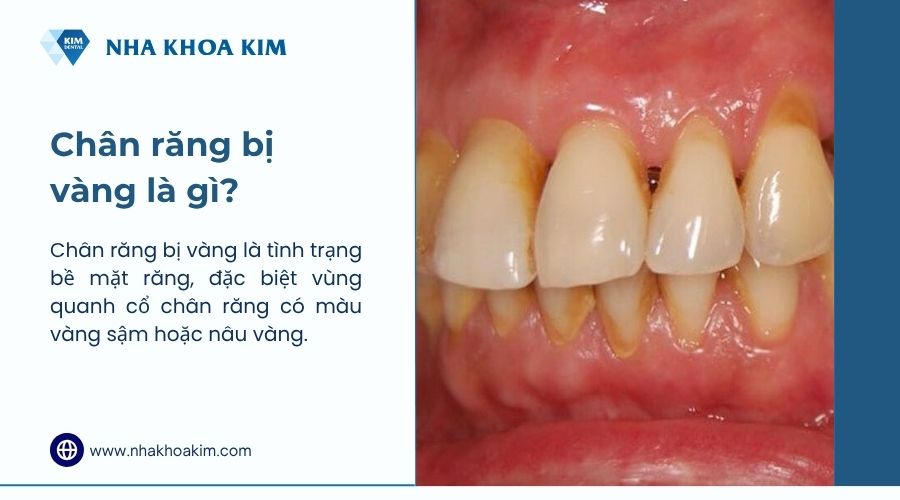 chân răng vàng là gì