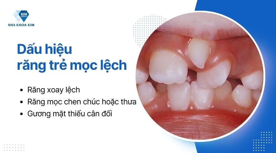 dấu hiệu răng trẻ mọc lệch