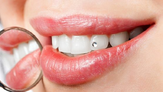 Đính kim cương lên răng – Khách sành điệu, cá tính không nên bỏ qua