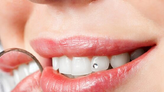 Đính kim cương lên răng – Khách sành điệu, cá tính không nên bỏ qua