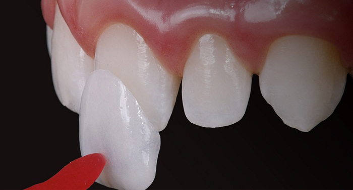 Các phương pháp điều trị khi đã mắc mẻ răng