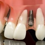 Có nên chọn implant Hàn Quốc để trồng răng hay không? Có nên chọn implant Hàn Quốc để trồng răng hay không?