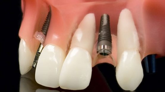 Có nên chọn Implant Hàn Quốc để trồng răng hay không?
