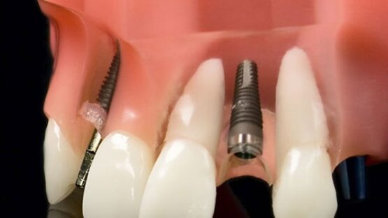 Top 5 loại trụ Implant Hàn Quốc chất lượng tốt hiện nay