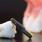 Implant loại nào tốt nhất được nhiều người lựa chọn? Implant loại nào tốt nhất được nhiều người lựa chọn?