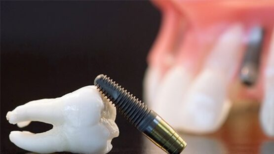 Cấy Implant loại nào tốt và được nhiều người lựa chọn?