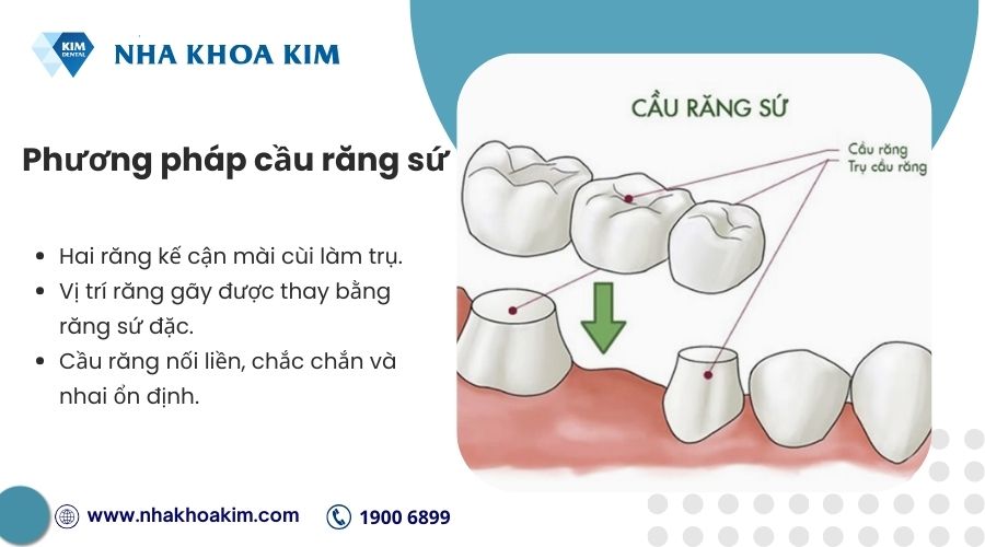 Cầu răng sứ phục hình răng gãy