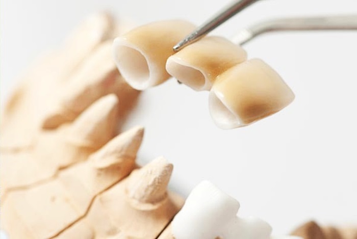 Cầu răng sứ - Phương pháp thay thế răng răng mất tiết kiệm, nhanh chóng 1