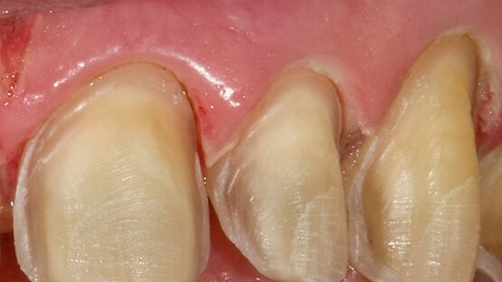 Mài răng nanh và những lưu ý quan trọng bạn nên biết