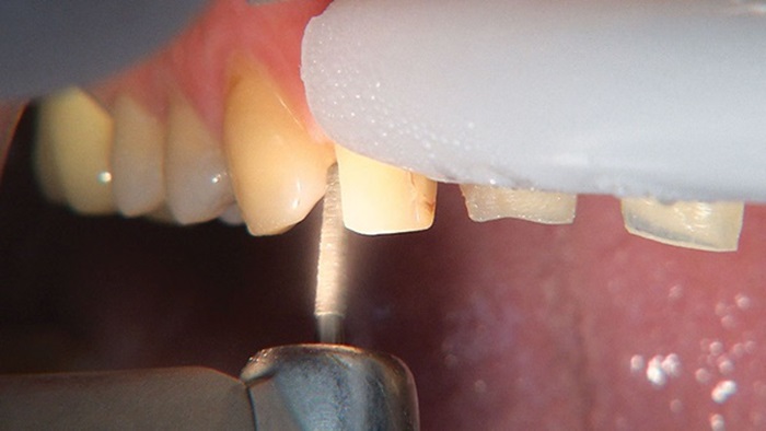 Quy trình bọc răng sứ thẩm mỹ ĐÚNG, CHUẨN - Mài răng - Nha Khoa KIM