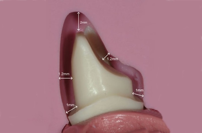Làm răng giả vampire bằng cách nào nhanh và đẹp hiệu quả? 3
