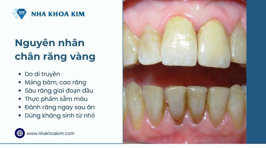 Nguyên nhân chân răng bị vàng