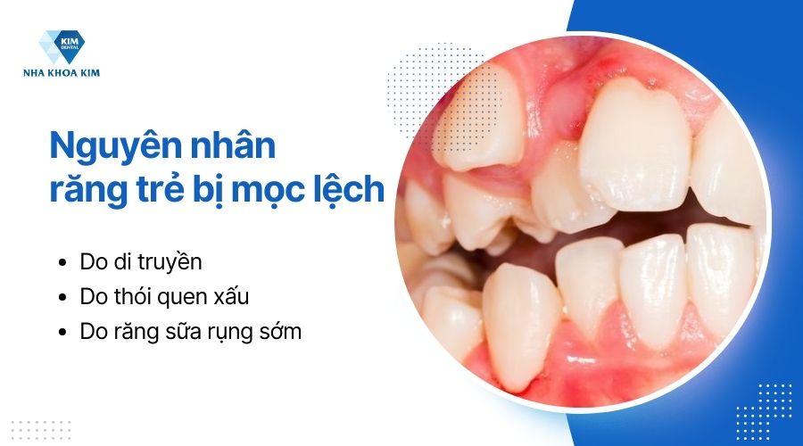 nguyên nhân răng bị khấp khểnh