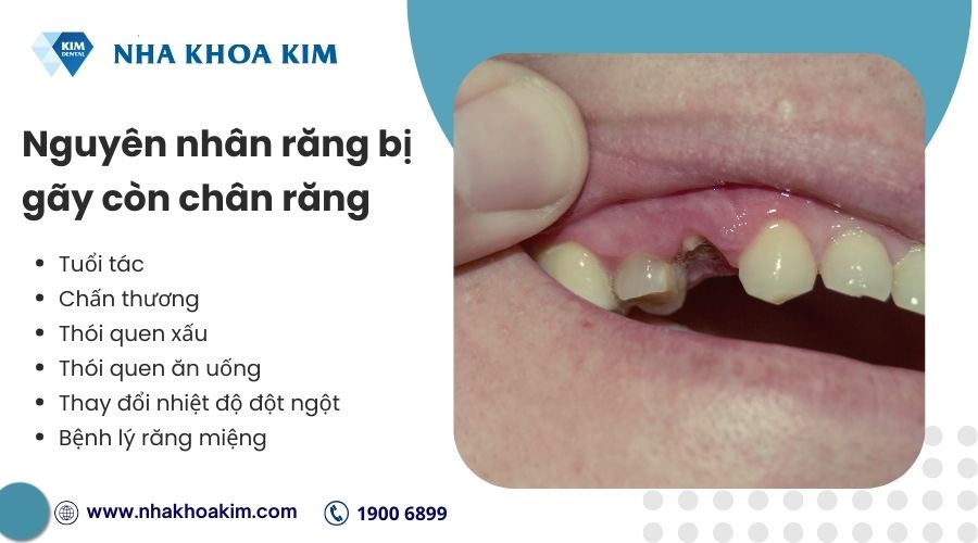 nguyên nhân răng bị gãy còn chân răng