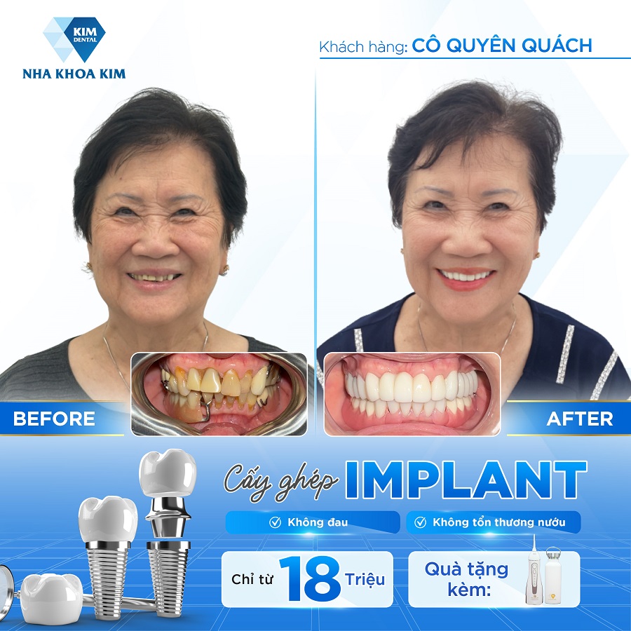 Hình ảnh khách hàng trước - sau khi tới với Nha Khoa Kim