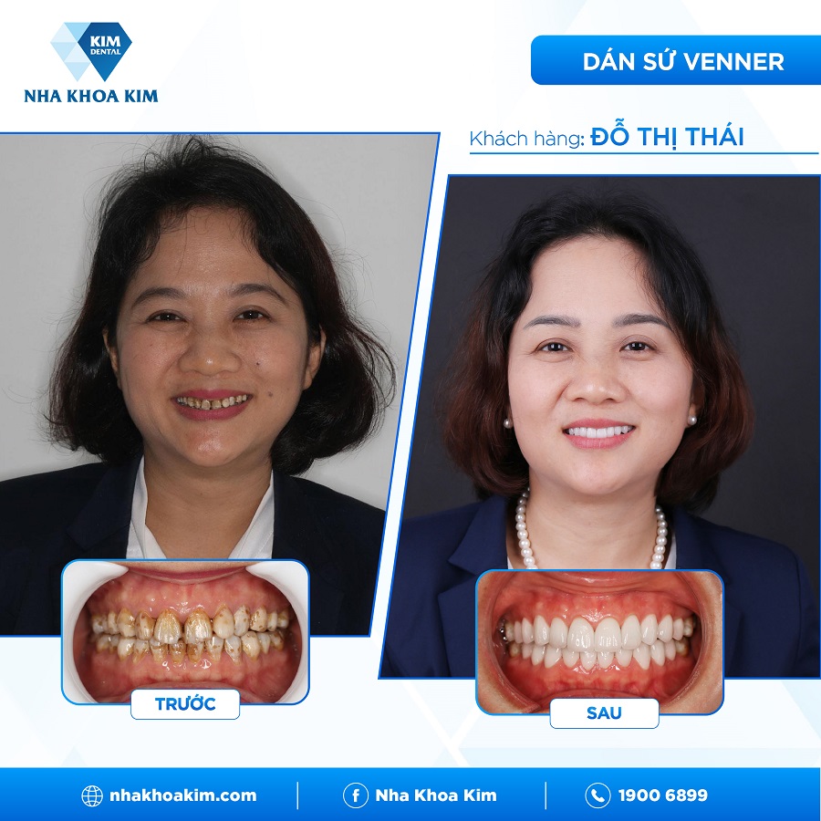 Hình ảnh trước - sau của khách hàng khi tới với Nha Khoa Tiền Giang