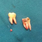 Nhổ chân răng còn sót - Cách nhận biết và xử lý chuẩn an toàn Nhổ chân răng còn sót - Cách nhận biết và xử lý chuẩn an toàn