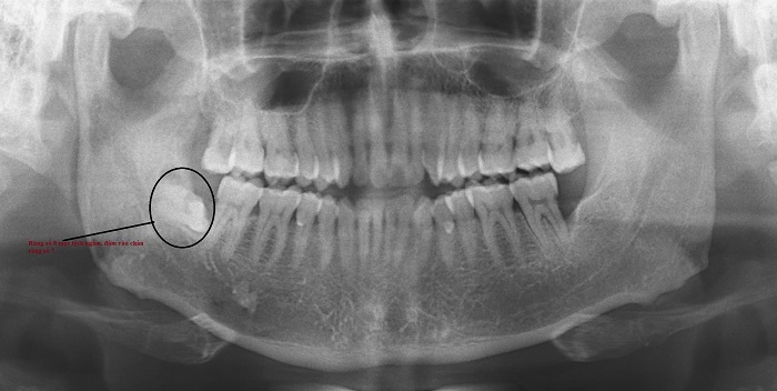 Chụp phim X-quang sẽ nhìn thấy vị trí chân răng còn sót trên cung hàm