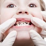 Nhổ răng sâu cho trẻ em - Những thông tin cơ bản cha mẹ nên biết Nhổ răng sâu cho trẻ em - Những thông tin cơ bản cha mẹ nên biết