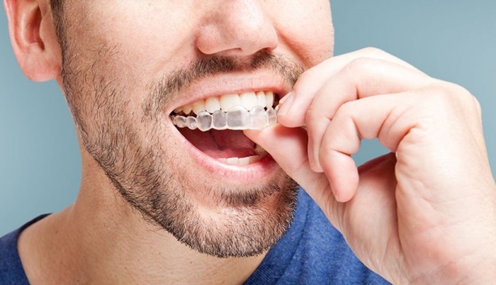 TOP 2 Địa chỉ niềng răng Invisalign tại Hà Nội không nên bỏ qua 1