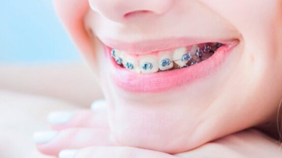 Nên chọn niềng răng loại nào tốt nhất và an toàn hiện nay?