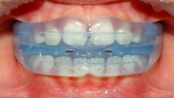 Niềng răng silicon – Những thông tin hữu ích không nên bỏ qua