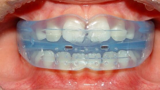 Niềng răng silicon – Những thông tin hữu ích không nên bỏ qua