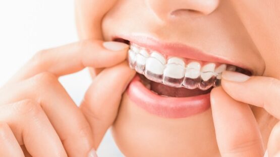 Niềng răng 3D Clear giá bao nhiêu tiền? Mức giá chuẩn điều trị?