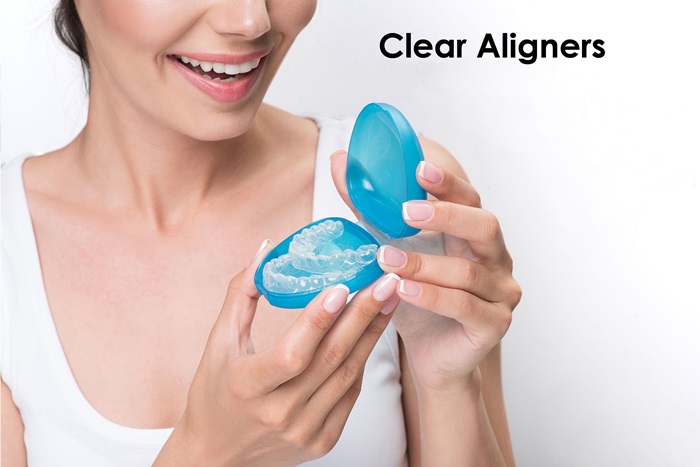 Niềng răng trong suốt Clear Aligner là gì? Hiệu quả điều trị có tốt không? 3