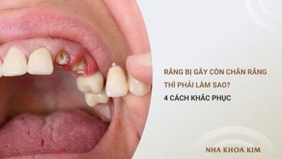 Răng bị gãy còn chân răng phải làm sao để ăn nhai lại bình thường