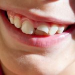 Răng bị gãy còn chân răng phải làm sao để ăn nhai lại bình thường Răng bị gãy còn chân răng phải làm sao để ăn nhai lại bình thường
