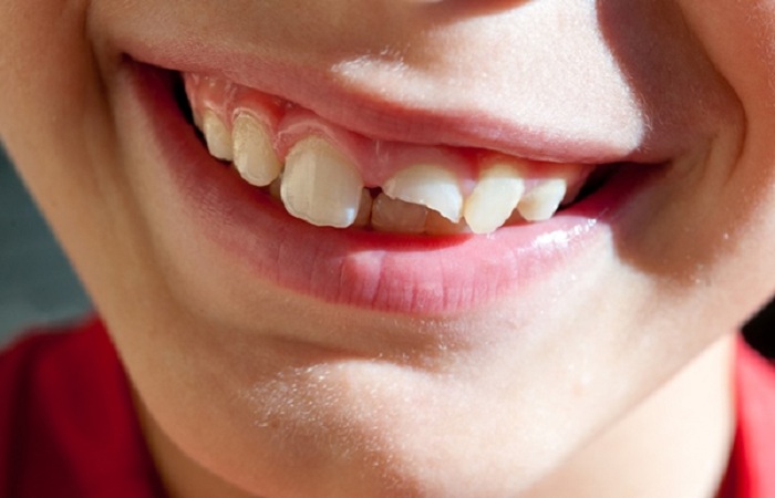 Răng bị gãy ngang làm ảnh hưởng đến sự sắp xếp răng và khớp cắn?