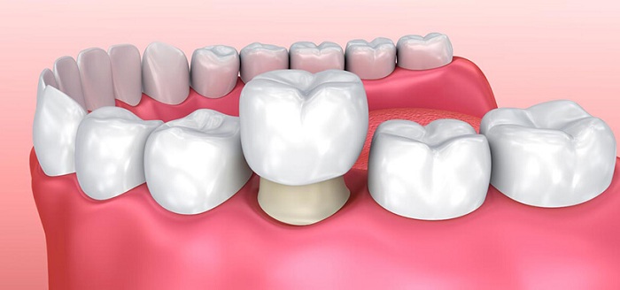 răng bị gãy còn chân răng phải làm sao - 3