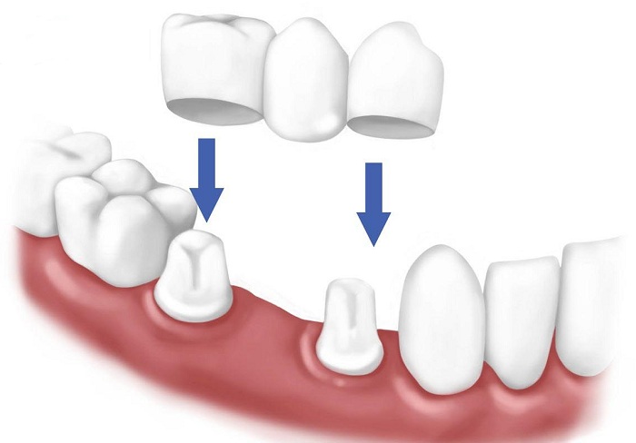 răng bị gãy còn chân răng phải làm sao - 4