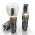 Những lưu ý khi trồng răng implant giúp đạt hiệu quả cao nhất Những lưu ý khi trồng răng implant giúp đạt hiệu quả cao nhất