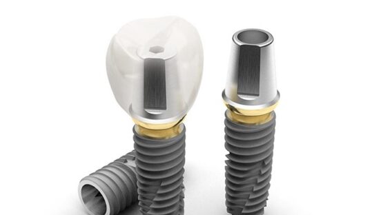 Trồng răng Implant của Đức – Ăn nhai thoải mái, bền chắc suốt đời