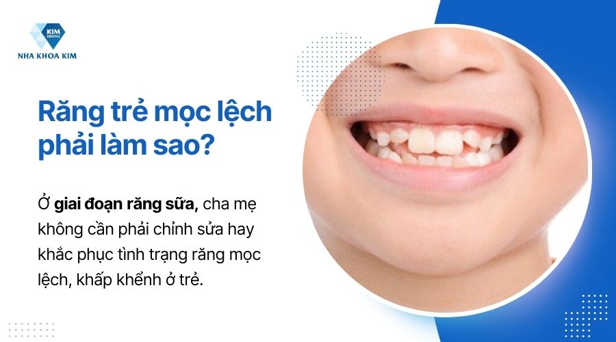 ở giai đoạn răng sữa cha mẹ không nên can thiệtp quá nhiều khi răng mọc lệch