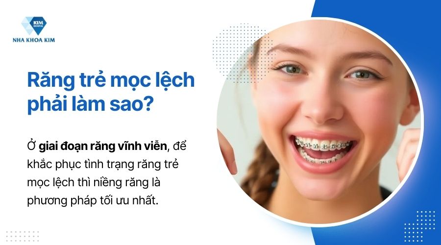 răng khấp khểnh ở giai đoạn răng vĩnh viễn cần phải chỉnh nha để khắc phục tình trạng này
