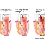 Áp xe chân răng - Nguyên nhân và cách chữa trị nhanh chóng, hiệu quả? Áp xe chân răng - Nguyên nhân và cách chữa trị nhanh chóng, hiệu quả?