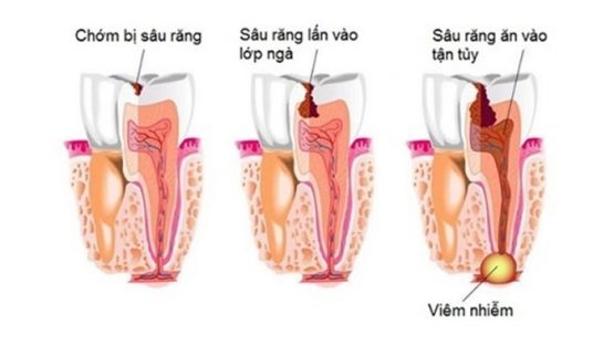 Áp xe chân răng – Nguyên nhân và cách chữa trị nhanh chóng, hiệu quả?