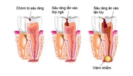 Áp xe chân răng – Nguyên nhân và cách chữa trị nhanh chóng, hiệu quả?