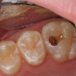 Răng sâu vào tủy – Dấu hiệu nhận biết và cách chữa trị hiệu quả Răng sâu vào tủy – Dấu hiệu nhận biết và cách chữa trị hiệu quả