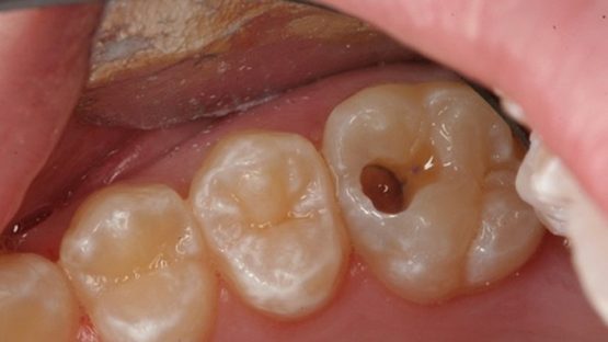 Răng sâu vào tủy – Dấu hiệu nhận biết và cách chữa trị hiệu quả
