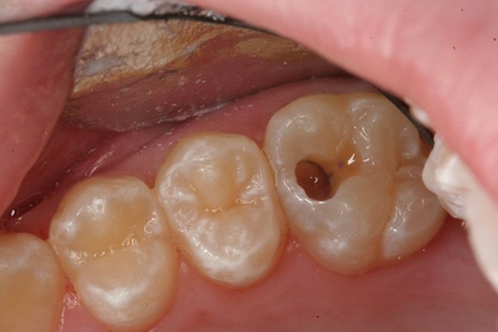 Răng khôn bị sâu nếu không được điều trị kịp thời sẽ gây ra nhiều hệ quả nặng nề